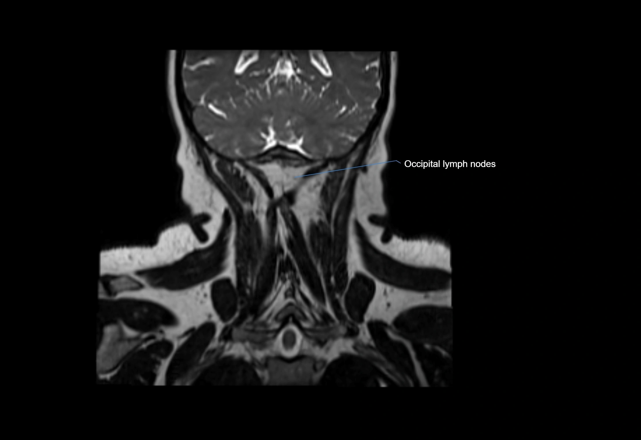 Neck coronal lymph node cross sectional MRI anatomy 3T MRI  image-img-00001-00013.webp